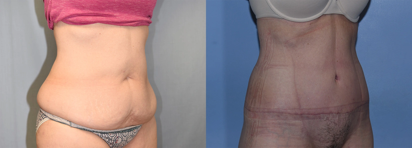 Real Patient Results of Dr. Wilson of Lake Norman Plastic Surgery