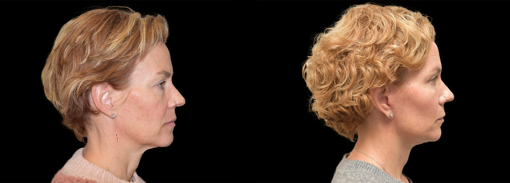 Real Patient Results of Dr. Wilson of Lake Norman Plastic Surgery