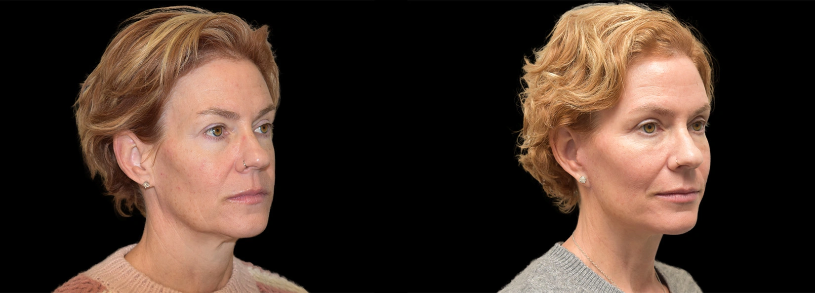 Real Patient Results of Dr. Wilson of Lake Norman Plastic Surgery