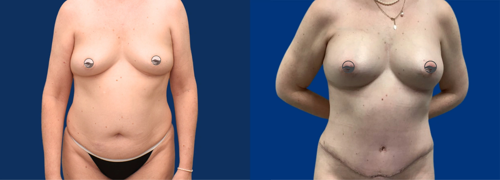 Real Patient Results of Dr. Wilson of Lake Norman Plastic Surgery