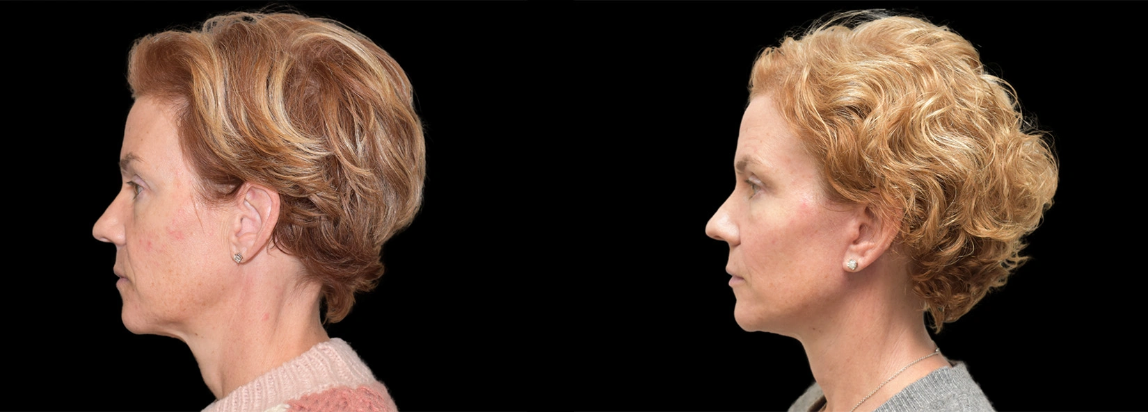 Real Patient Results of Dr. Wilson of Lake Norman Plastic Surgery