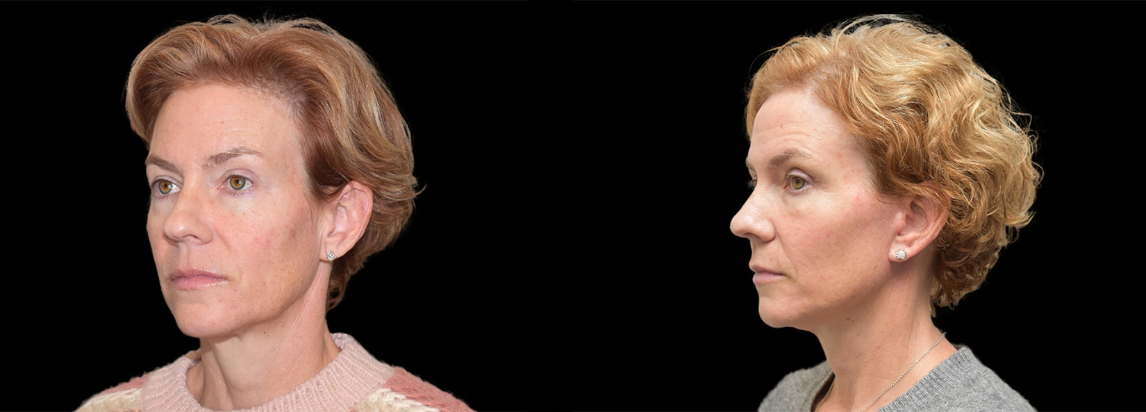 Real Patient Results of Dr. Wilson of Lake Norman Plastic Surgery