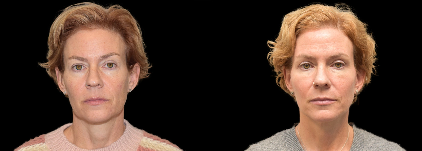 Real Patient Results of Dr. Wilson of Lake Norman Plastic Surgery