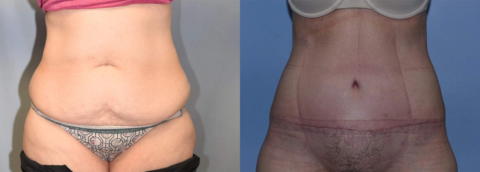 Real Patient Results of Dr. Wilson of Lake Norman Plastic Surgery