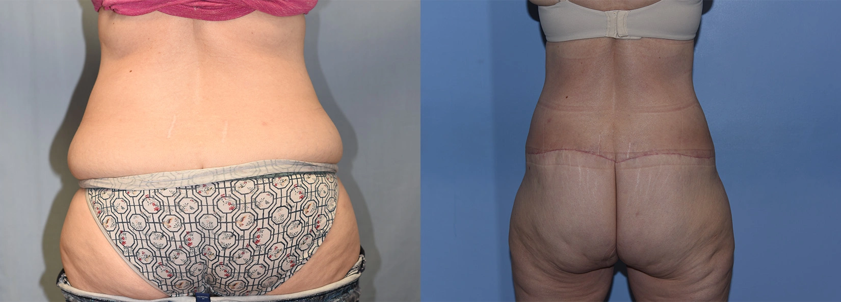 Real Patient Results of Dr. Wilson of Lake Norman Plastic Surgery