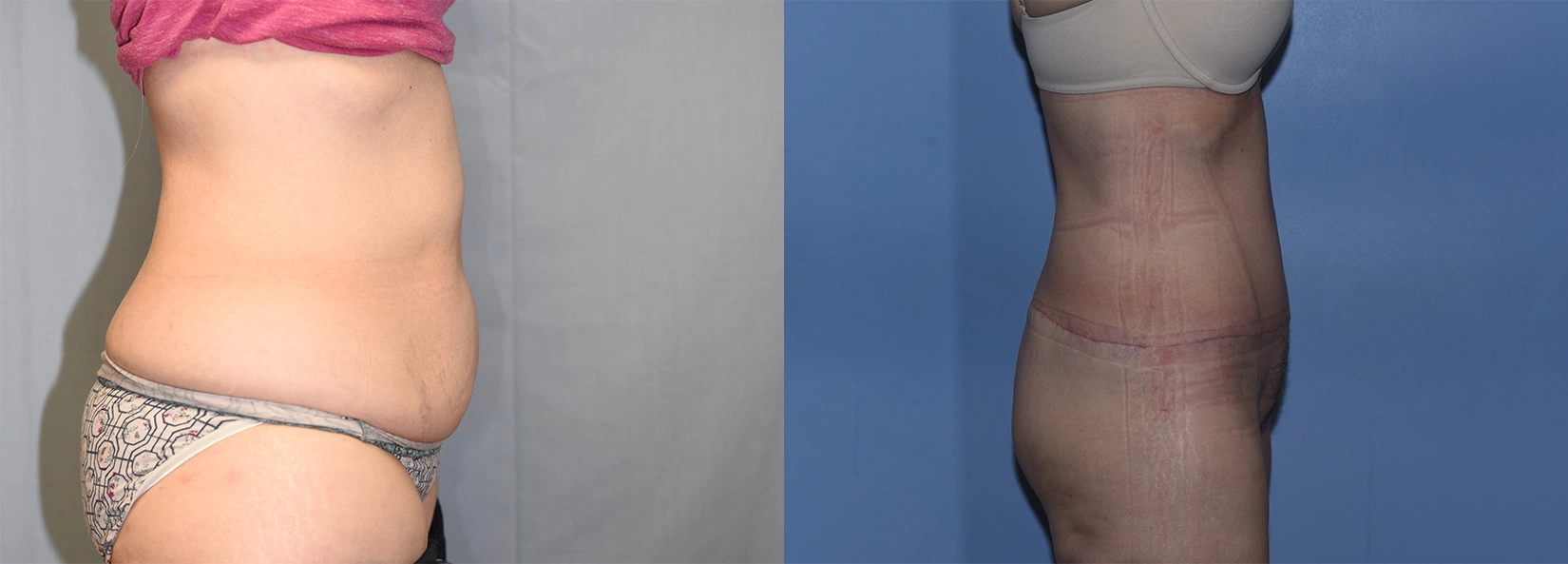 Real Patient Results of Dr. Wilson of Lake Norman Plastic Surgery