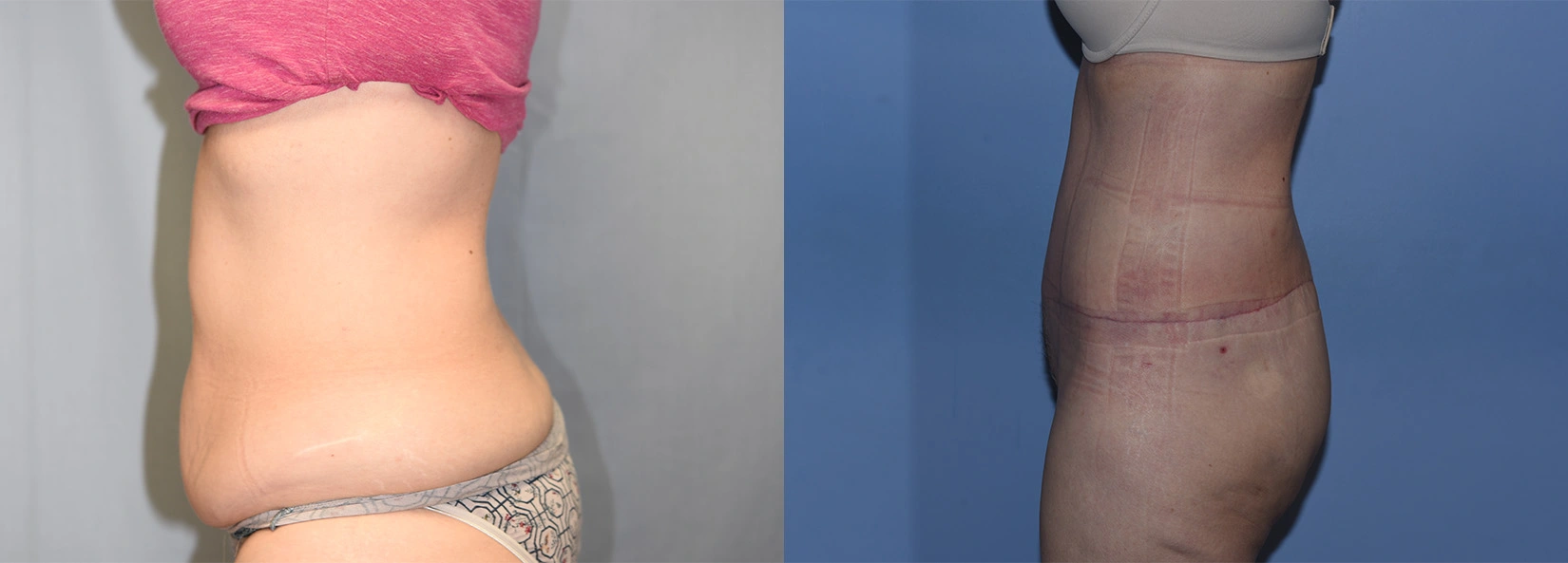 Real Patient Results of Dr. Wilson of Lake Norman Plastic Surgery