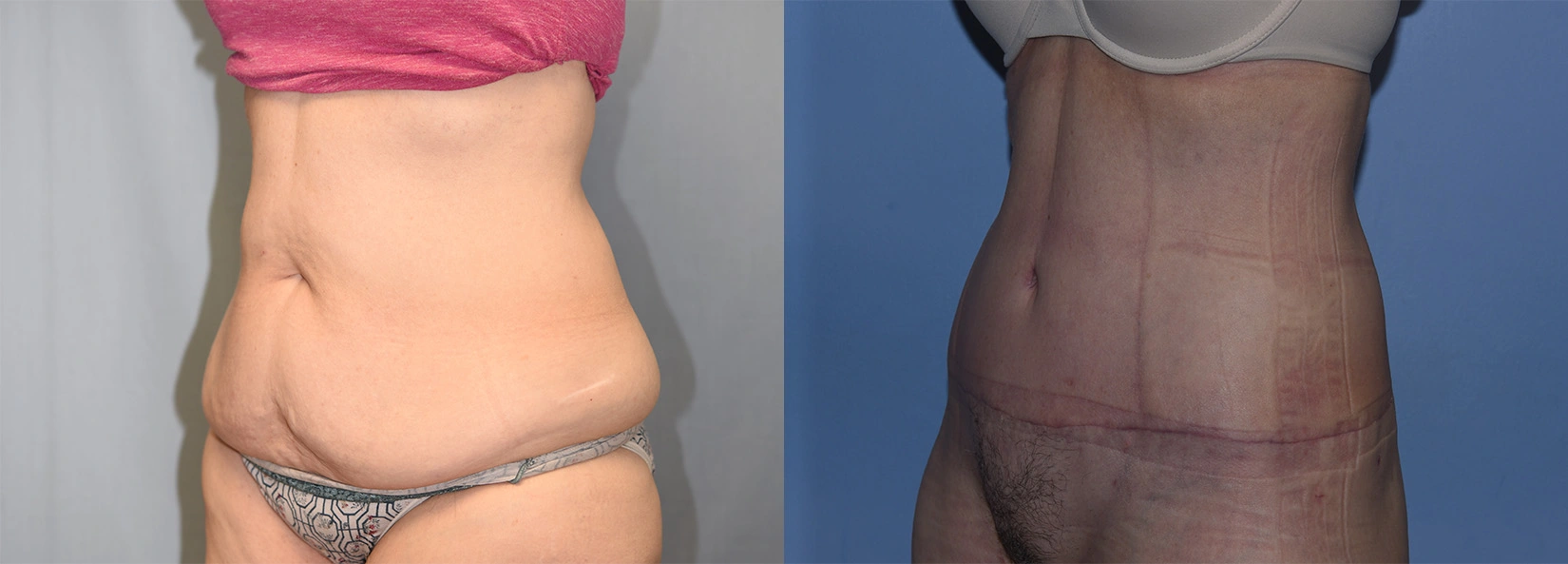 Real Patient Results of Dr. Wilson of Lake Norman Plastic Surgery