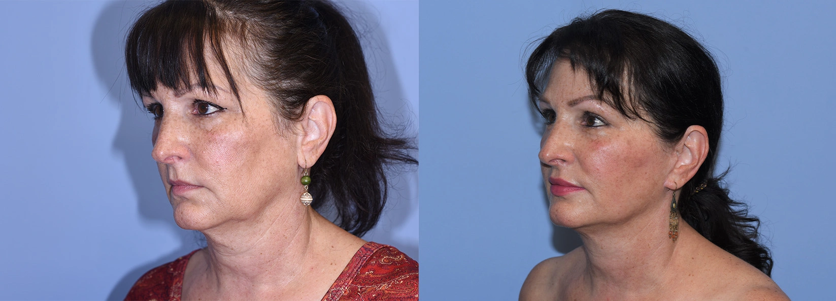 Real Patient Results of Dr. Wilson of Lake Norman Plastic Surgery