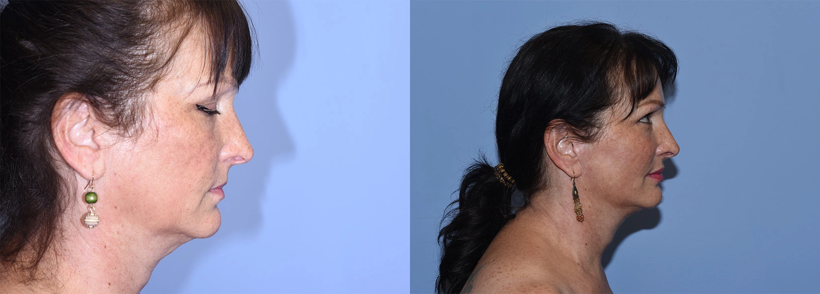 Real Patient Results of Dr. Wilson of Lake Norman Plastic Surgery