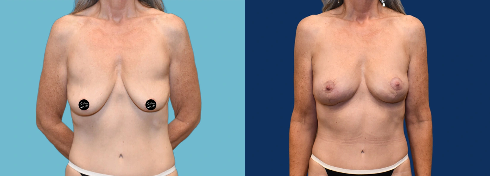 Real Patient Results of Dr. Wilson of Lake Norman Plastic Surgery