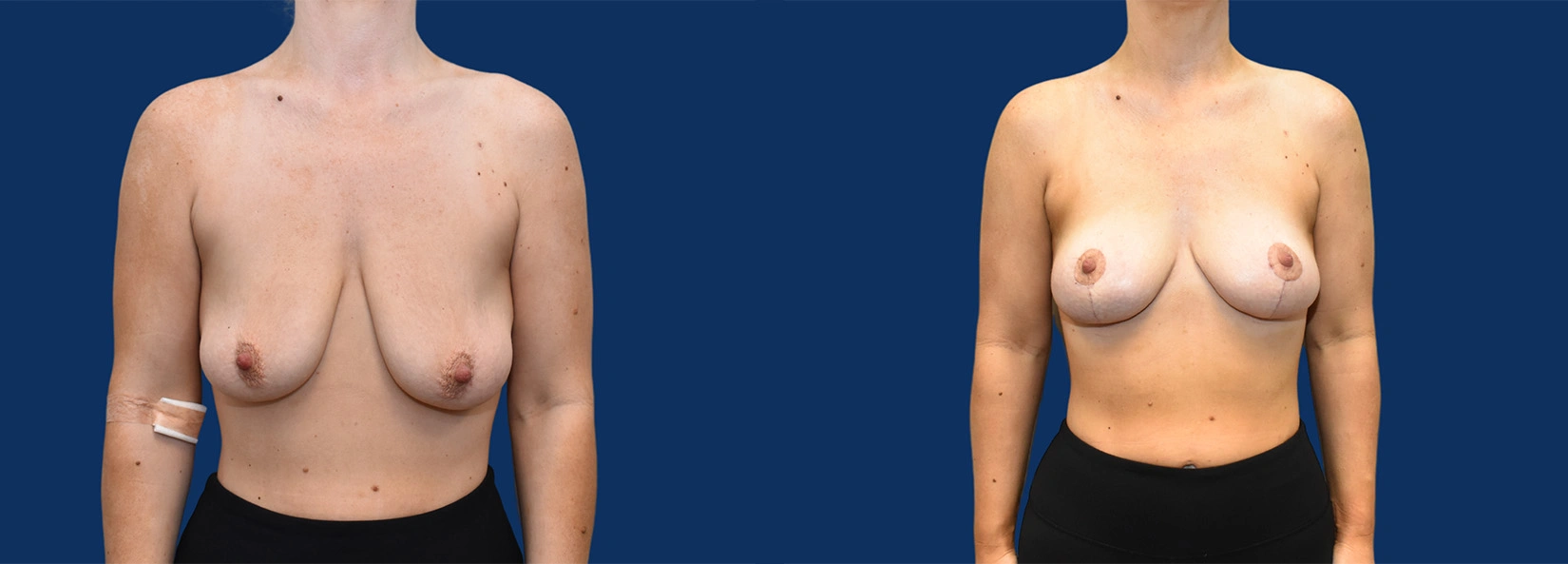 Real Patient Results of Dr. Wilson of Lake Norman Plastic Surgery