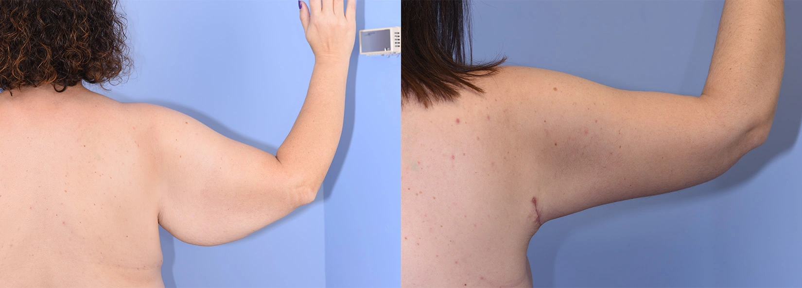 Real Patient Results of Dr. Wilson of Lake Norman Plastic Surgery