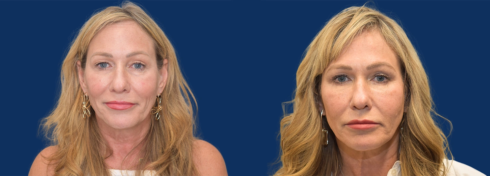 Real Patient Results of Dr. Wilson of Lake Norman Plastic Surgery