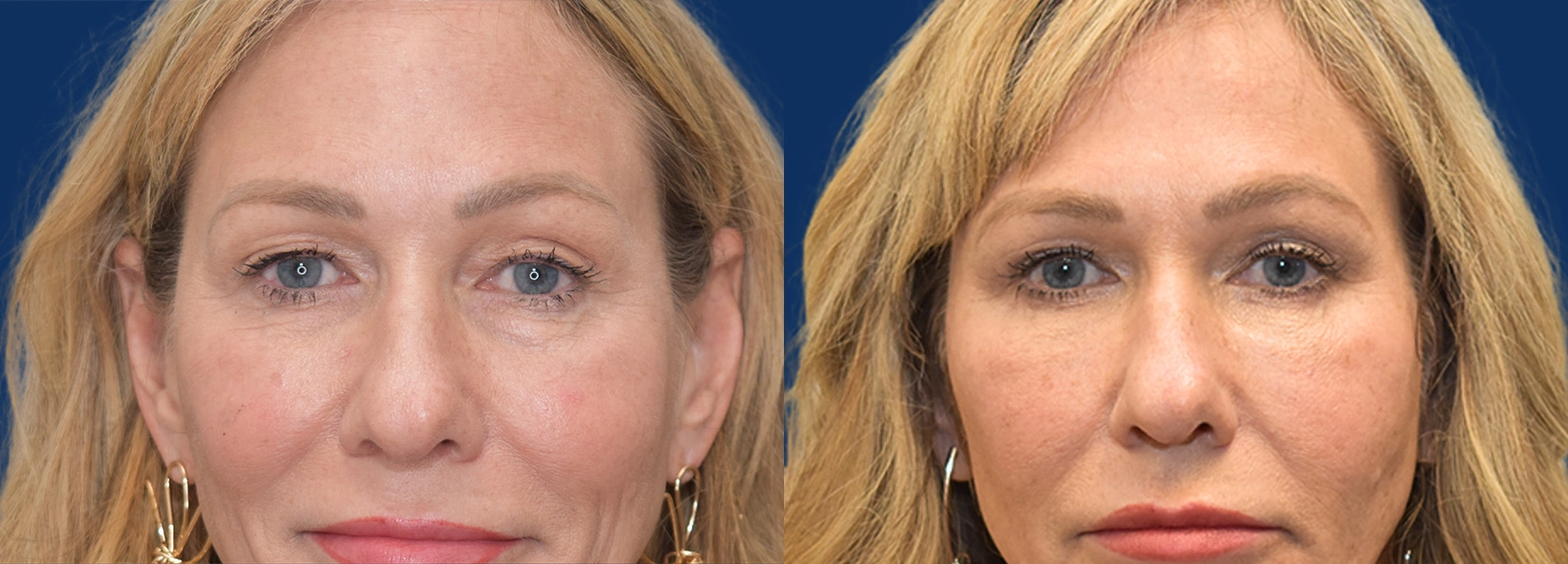 Real Patient Results of Dr. Wilson of Lake Norman Plastic Surgery