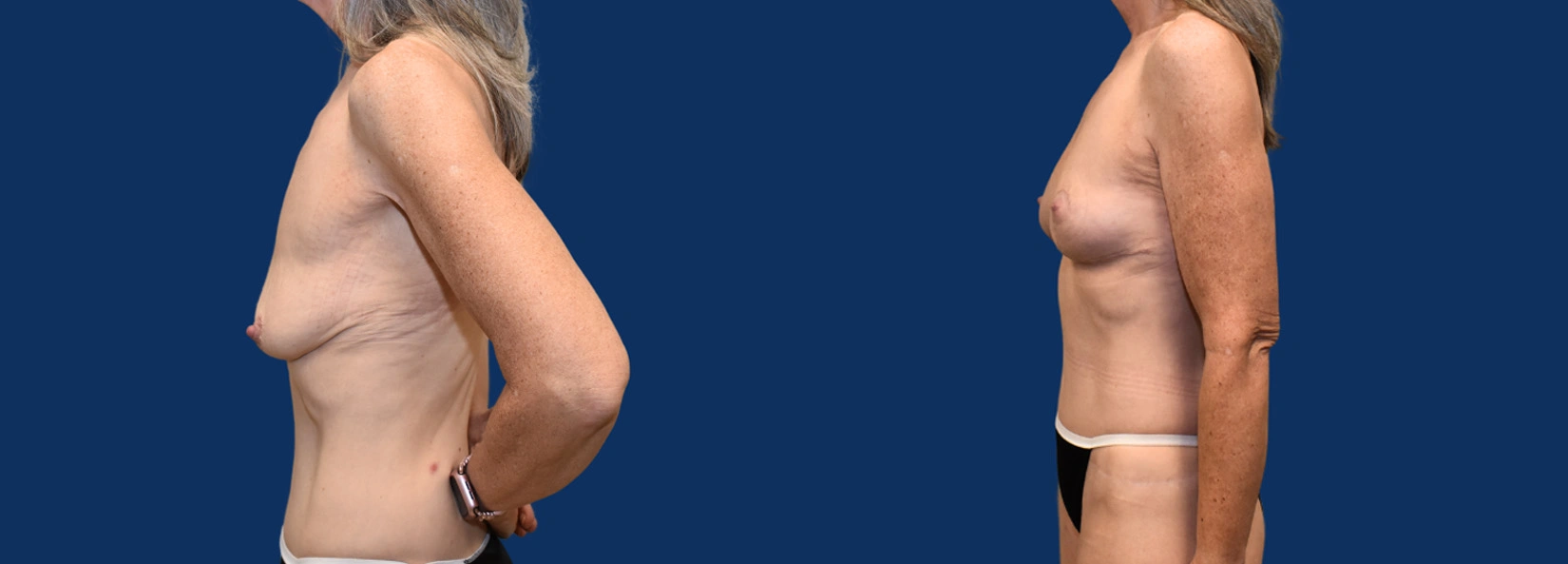 Real Patient Results of Dr. Wilson of Lake Norman Plastic Surgery