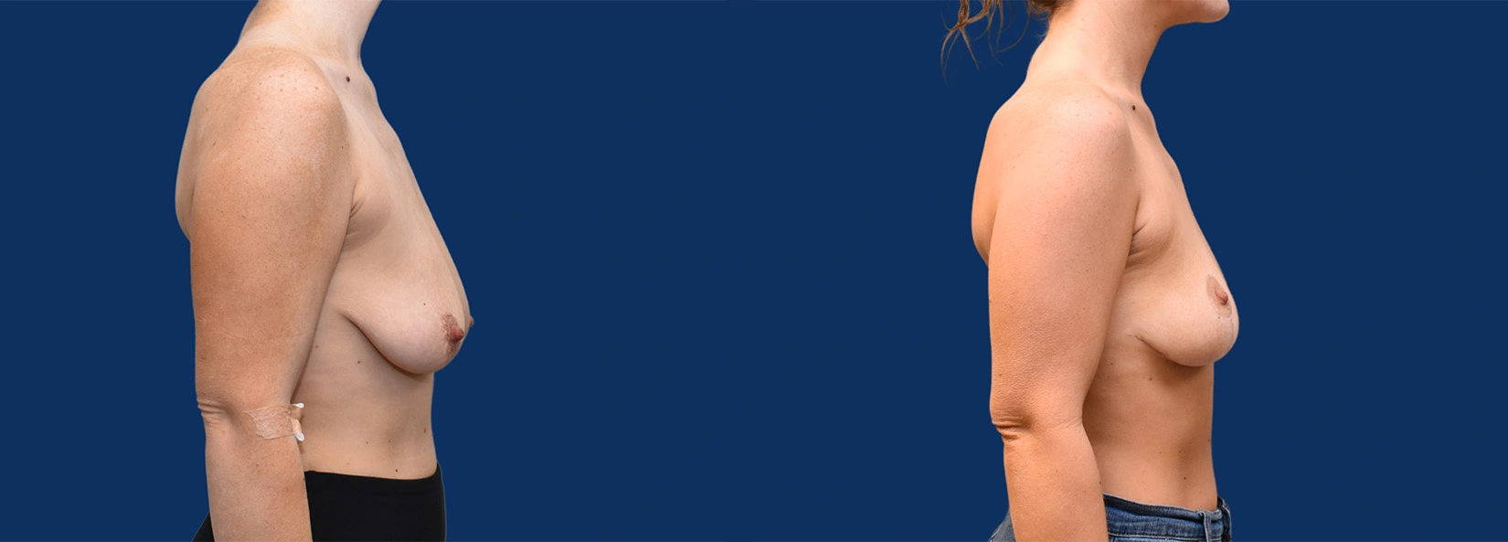 Real Patient Results of Dr. Wilson of Lake Norman Plastic Surgery