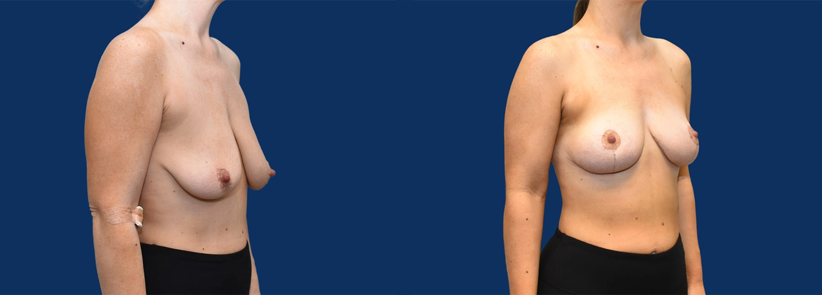 Real Patient Results of Dr. Wilson of Lake Norman Plastic Surgery