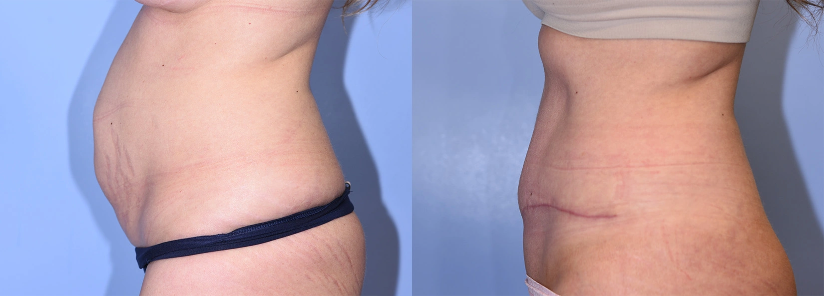 Real Patient Results of Dr. Wilson of Lake Norman Plastic Surgery