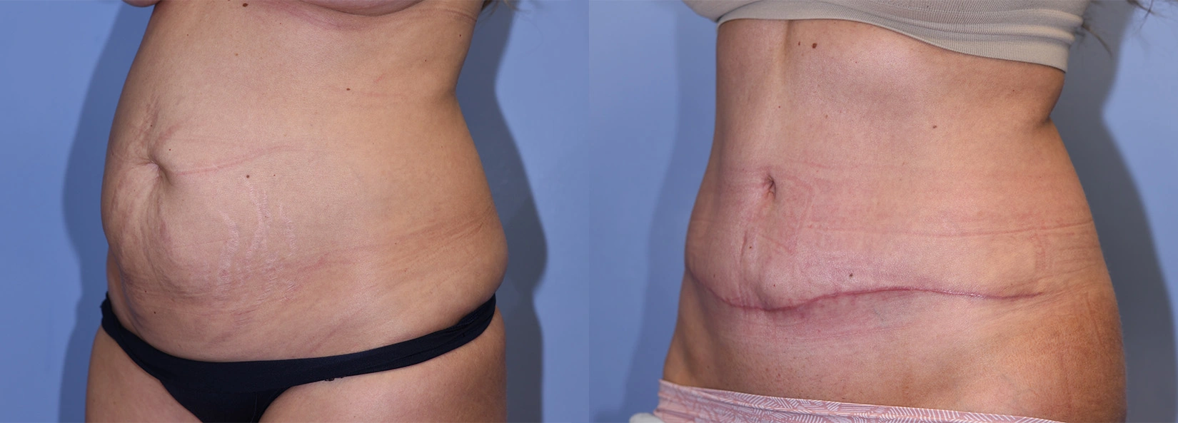Real Patient Results of Dr. Wilson of Lake Norman Plastic Surgery