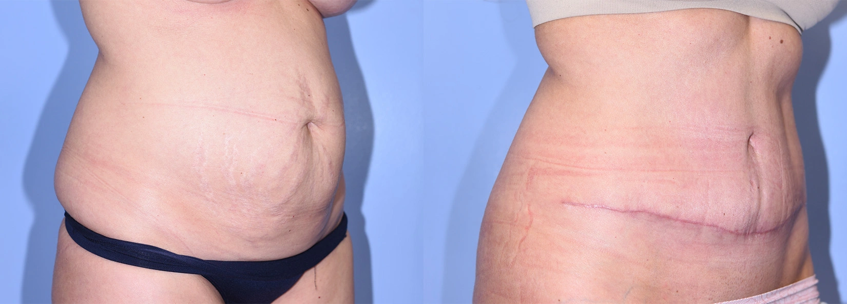 Real Patient Results of Dr. Wilson of Lake Norman Plastic Surgery