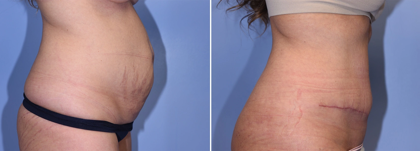 Real Patient Results of Dr. Wilson of Lake Norman Plastic Surgery