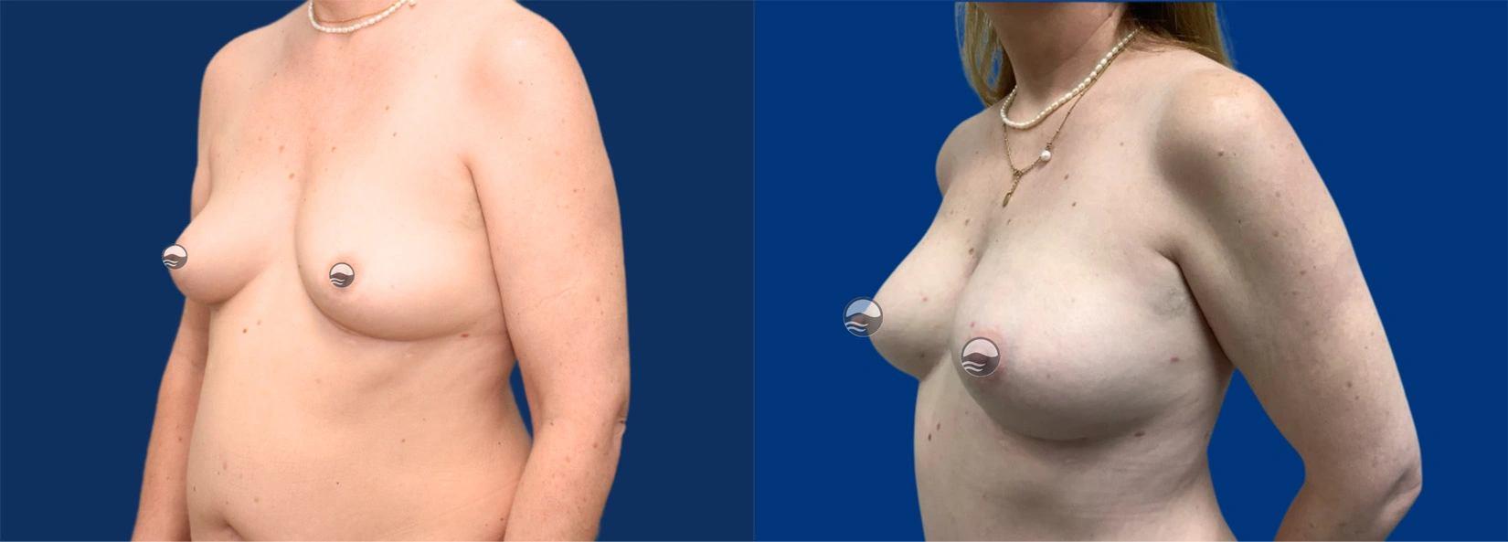 Real Patient Results of Dr. Wilson of Lake Norman Plastic Surgery