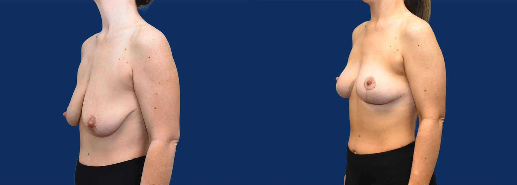 Real Patient Results of Dr. Wilson of Lake Norman Plastic Surgery