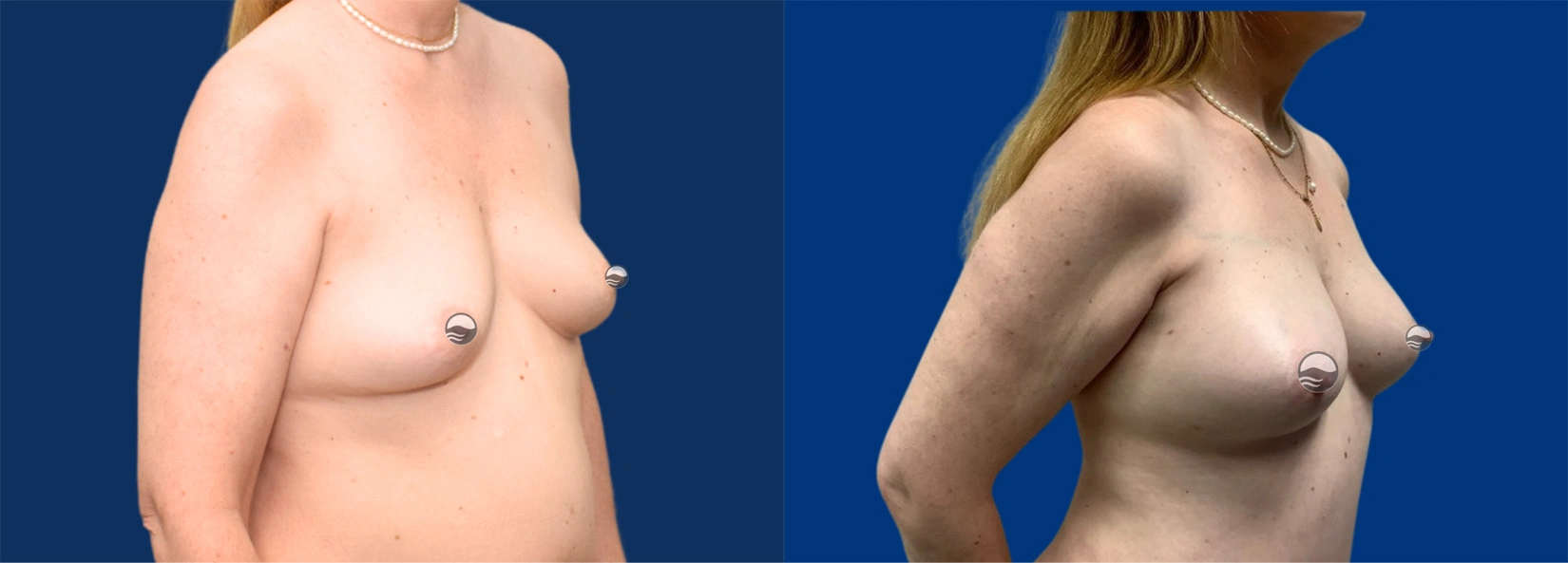 Real Patient Results of Dr. Wilson of Lake Norman Plastic Surgery