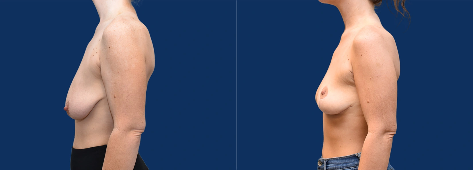 Real Patient Results of Dr. Wilson of Lake Norman Plastic Surgery