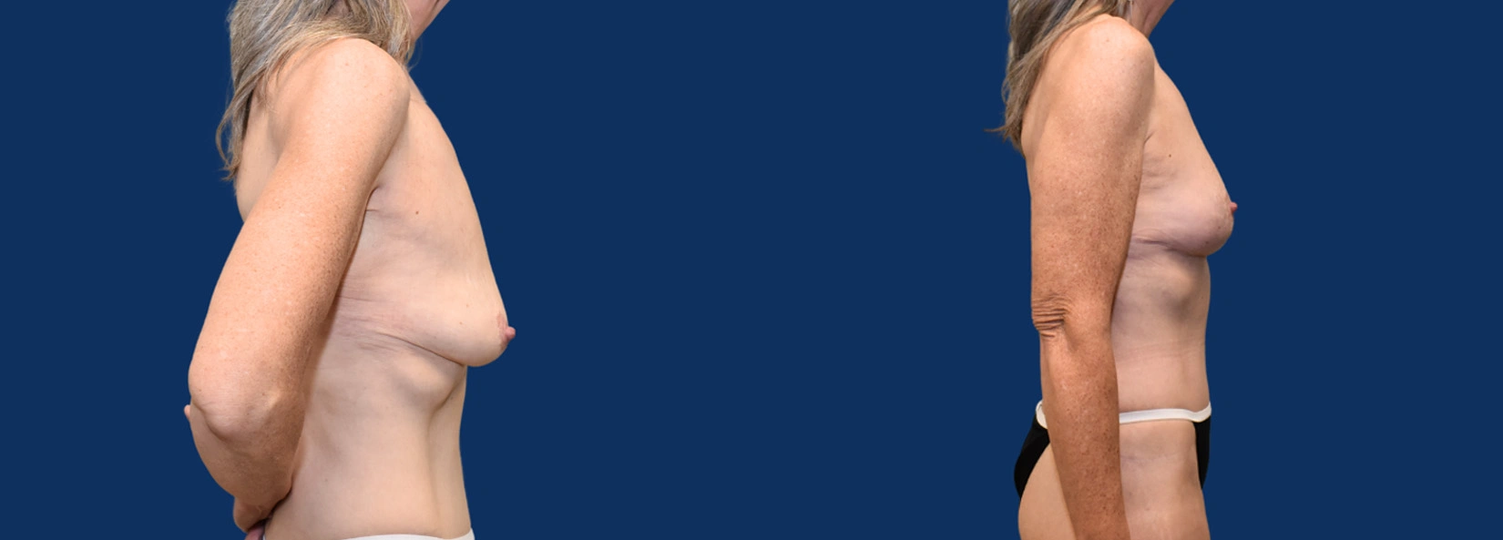 Real Patient Results of Dr. Wilson of Lake Norman Plastic Surgery