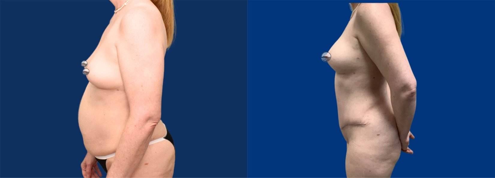 Real Patient Results of Dr. Wilson of Lake Norman Plastic Surgery