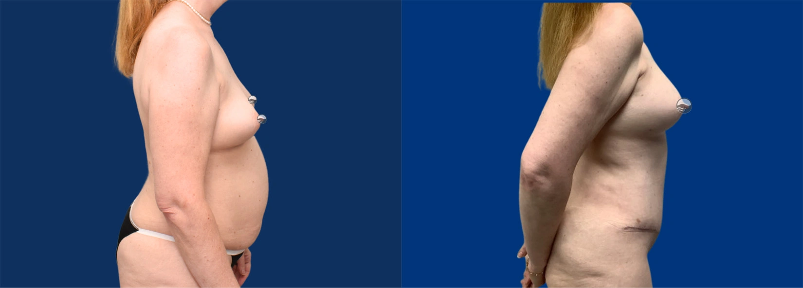 Real Patient Results of Dr. Wilson of Lake Norman Plastic Surgery