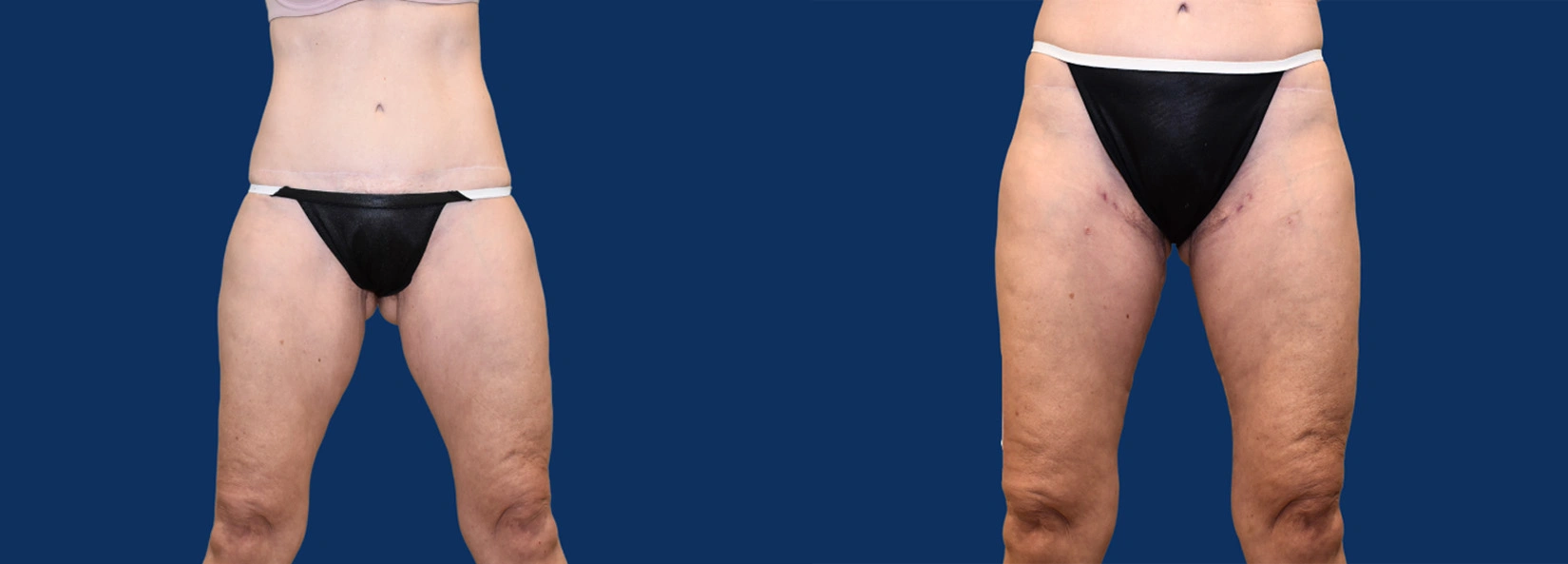 Real Patient Results of Dr. Wilson of Lake Norman Plastic Surgery