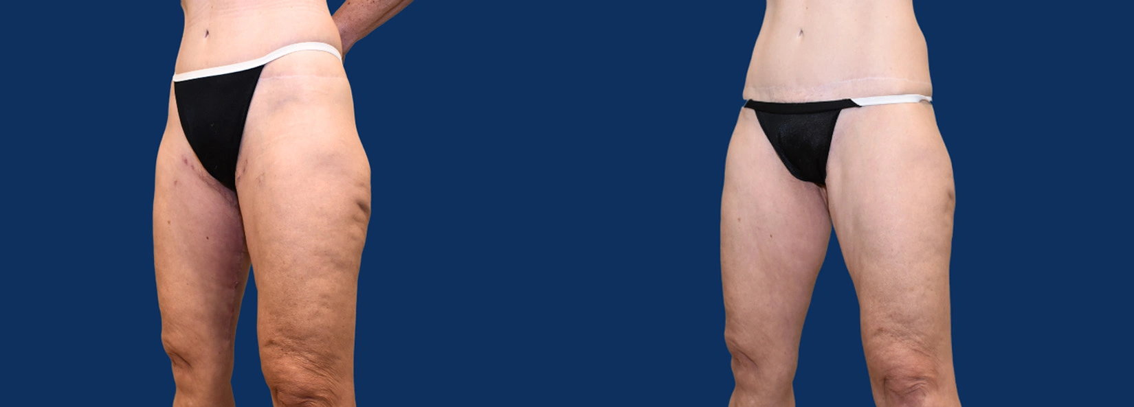 Real Patient Results of Dr. Wilson of Lake Norman Plastic Surgery