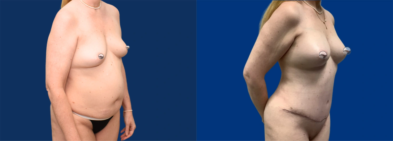 Real Patient Results of Dr. Wilson of Lake Norman Plastic Surgery