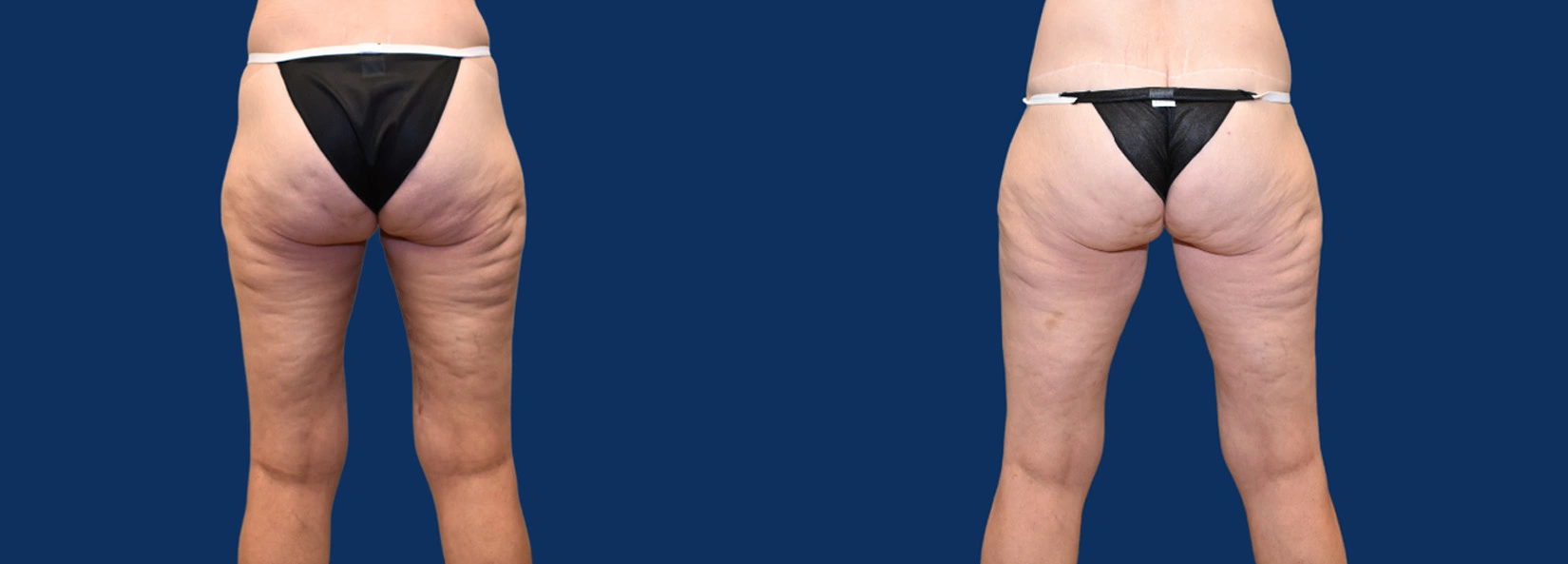 Real Patient Results of Dr. Wilson of Lake Norman Plastic Surgery