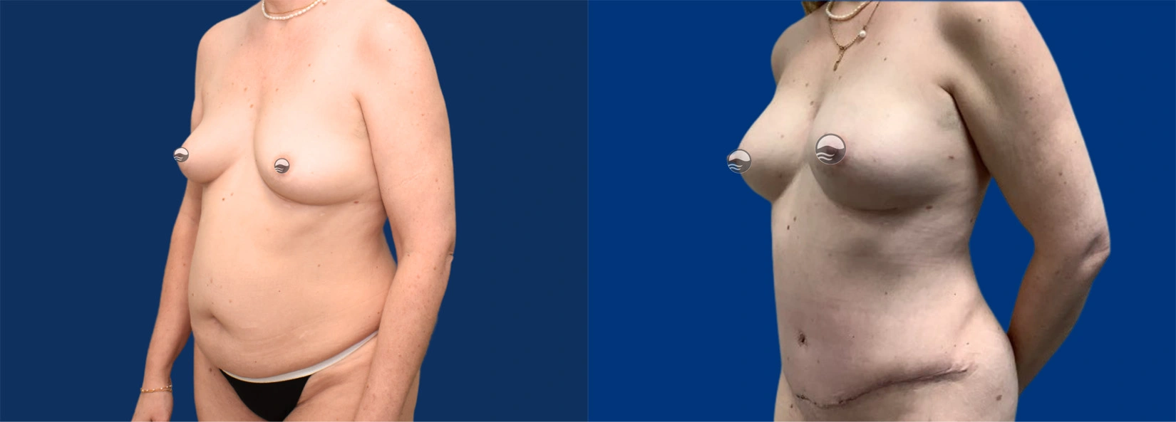 Real Patient Results of Dr. Wilson of Lake Norman Plastic Surgery