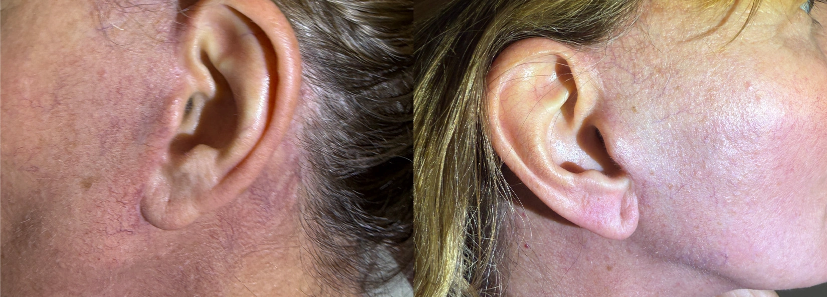 Real Patient Results of Dr. Wilson of Lake Norman Plastic Surgery