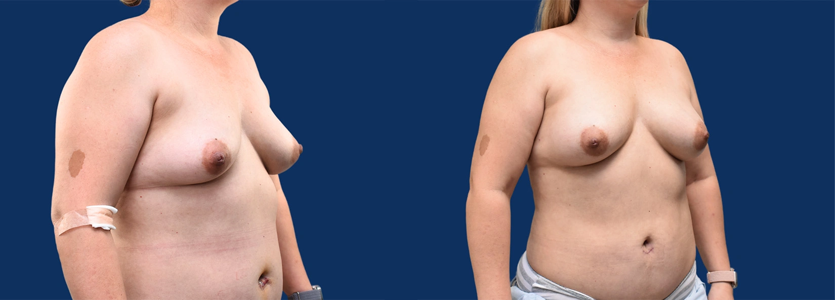 Real Patient Results of Dr. Wilson of Lake Norman Plastic Surgery