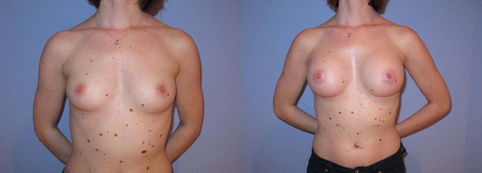 Real Patient Results of Dr. Wilson of Lake Norman Plastic Surgery