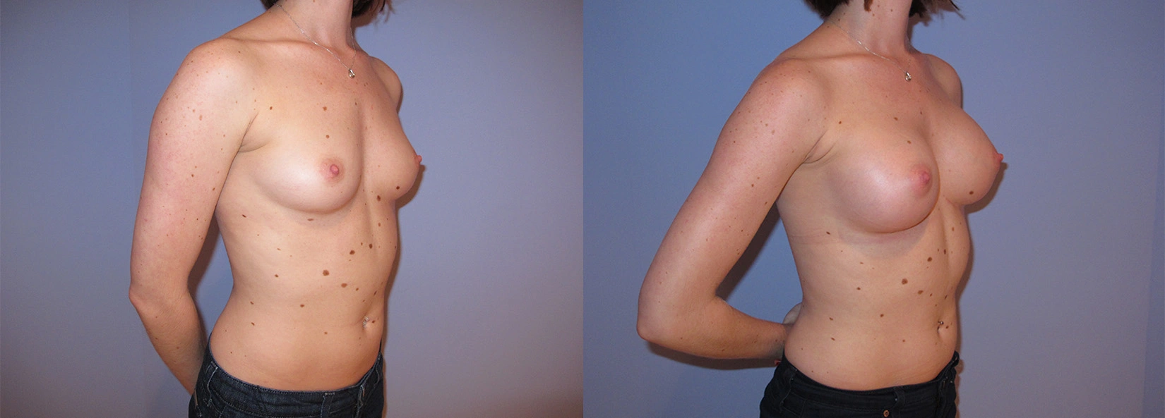 Real Patient Results of Dr. Wilson of Lake Norman Plastic Surgery