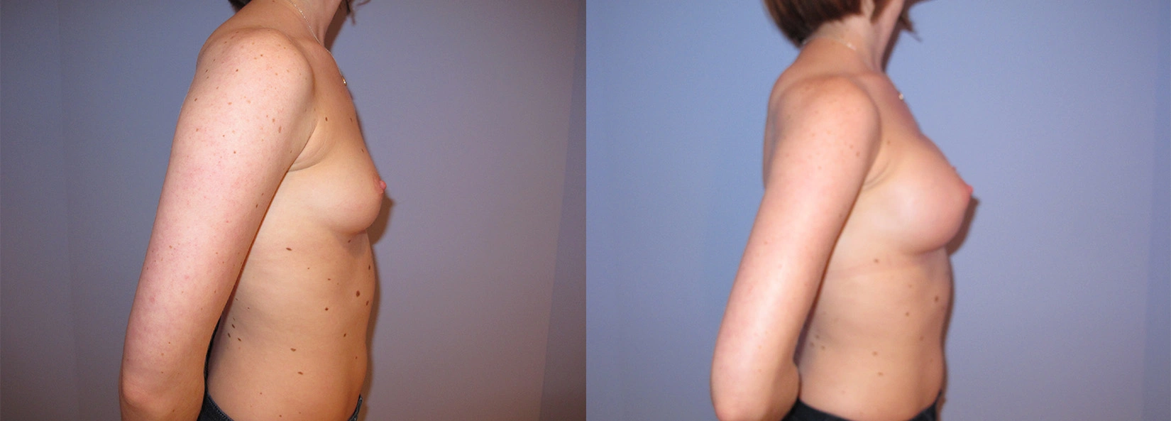 Real Patient Results of Dr. Wilson of Lake Norman Plastic Surgery