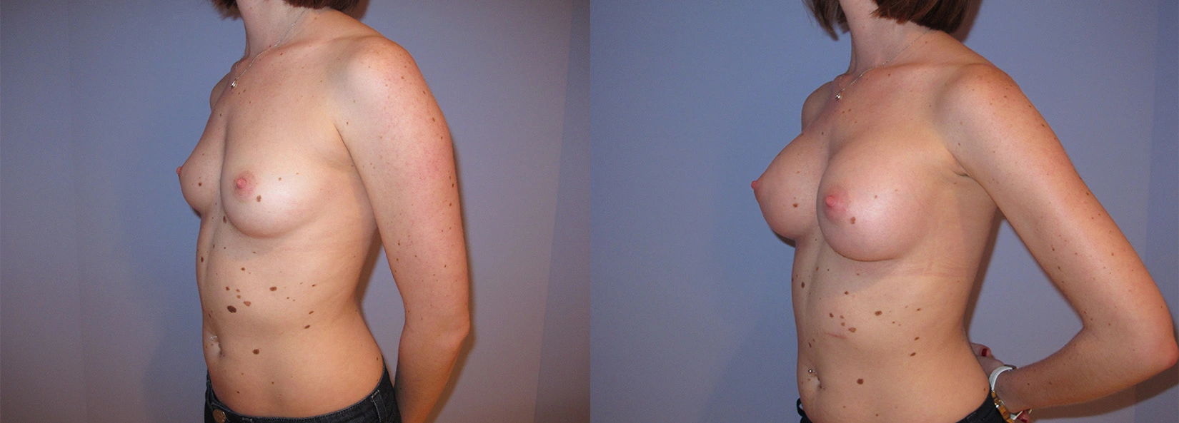 Real Patient Results of Dr. Wilson of Lake Norman Plastic Surgery