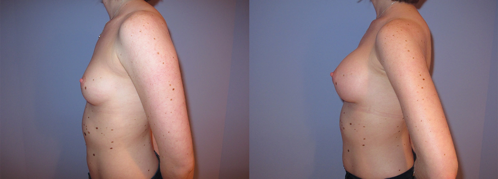 Real Patient Results of Dr. Wilson of Lake Norman Plastic Surgery