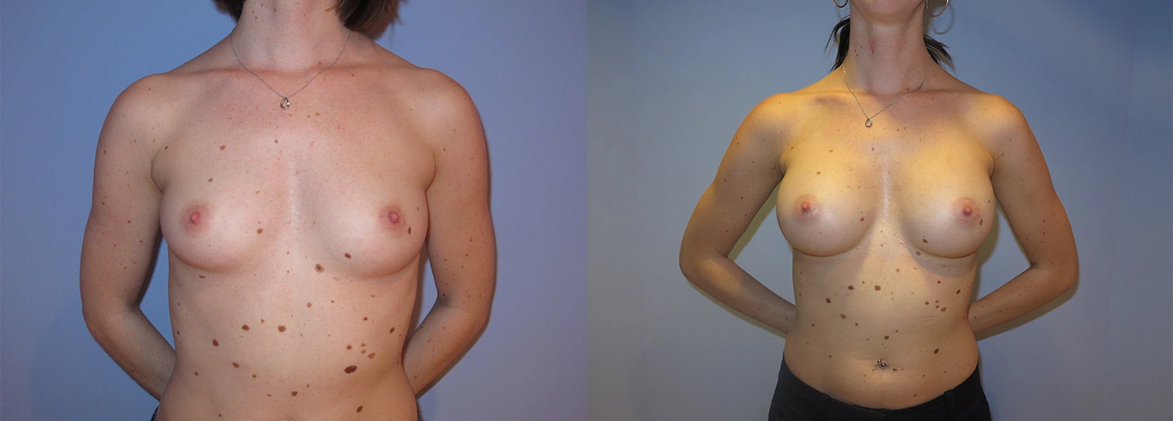 Real Patient Results of Dr. Wilson of Lake Norman Plastic Surgery