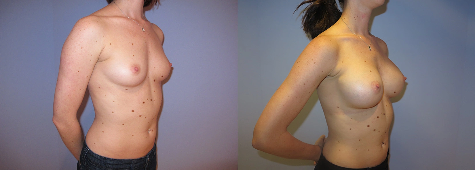Real Patient Results of Dr. Wilson of Lake Norman Plastic Surgery