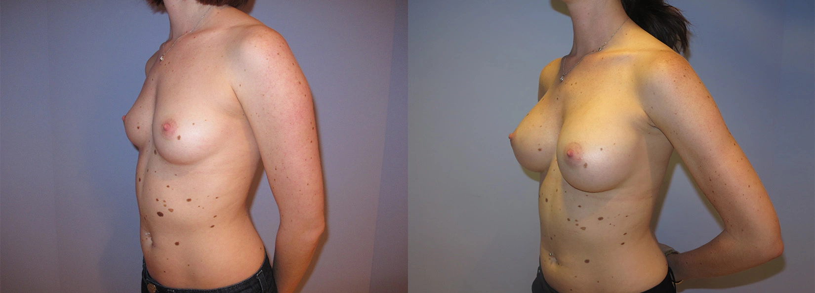 Real Patient Results of Dr. Wilson of Lake Norman Plastic Surgery