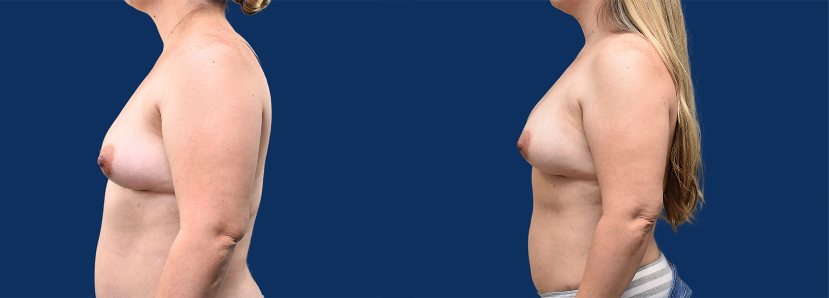 Real Patient Results of Dr. Wilson of Lake Norman Plastic Surgery