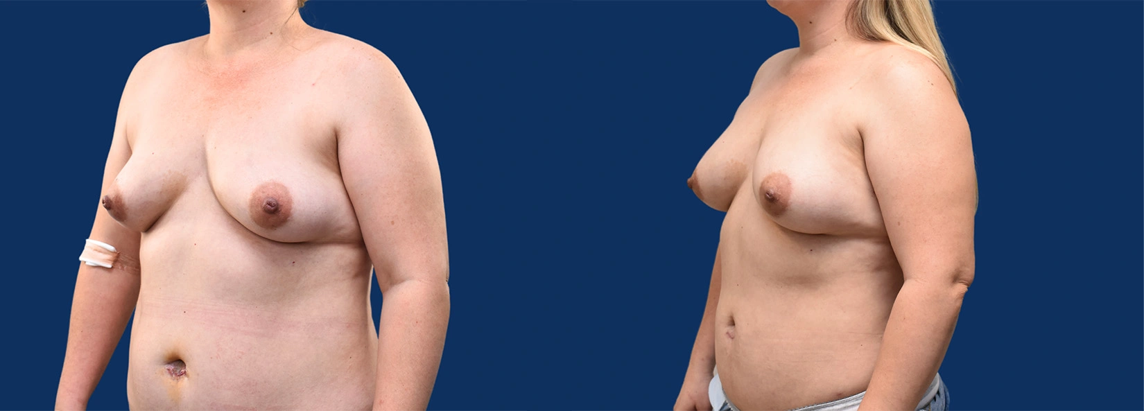 Real Patient Results of Dr. Wilson of Lake Norman Plastic Surgery